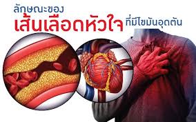 ไขมันอุดตัน