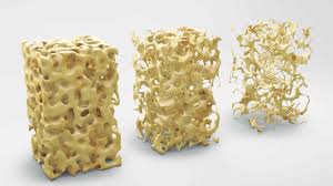 กระดูกพรุนมาก