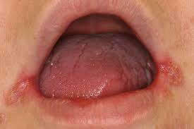 แผลที่มุมปาก