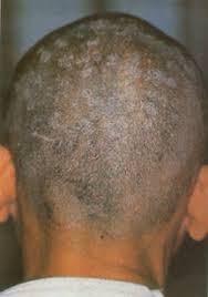 เกลื้อนที่หัว