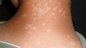 เกลื้อน