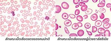 ธาลาสซีเมีย